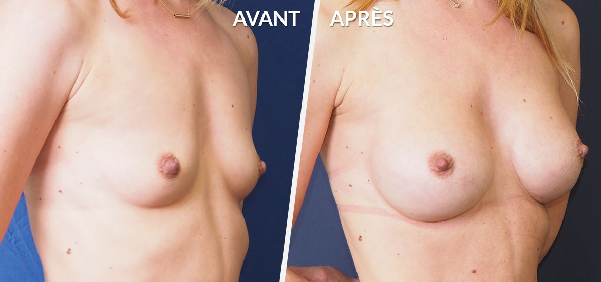 Exemple Augmentation mammaire 4