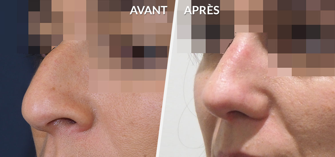 Exemple Rhinoplastie 5