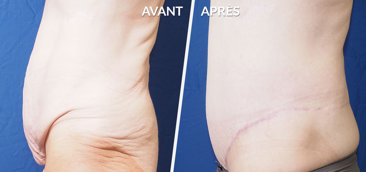 Exemple Bodylift / Dermolipectomie circulaire 1