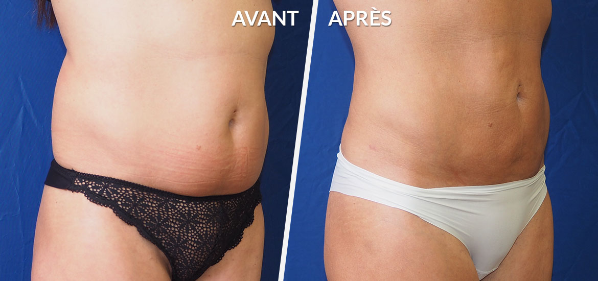 Exemple Lipoaspiration / Liposculture 1