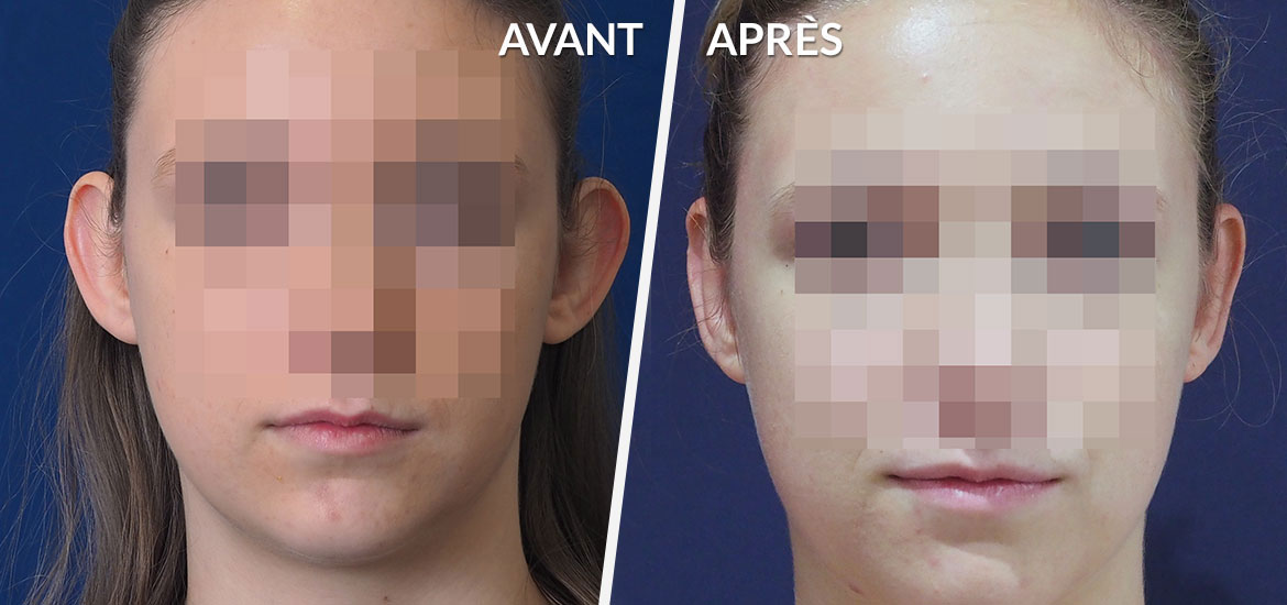 Exemple Otoplastie 2