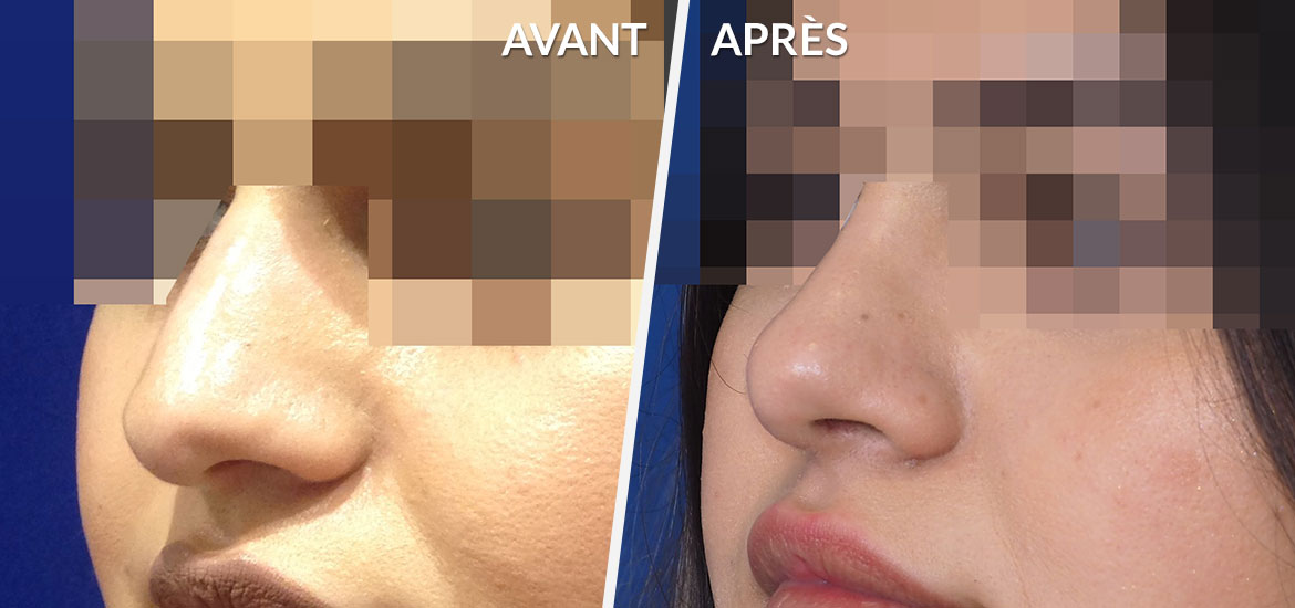 Exemple Rhinoplastie 1